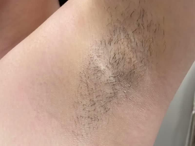 foto de Depilador a Laser IPL Mlay T4 Resfriamento a Gelo 5 Níveis 500000 Flashes
