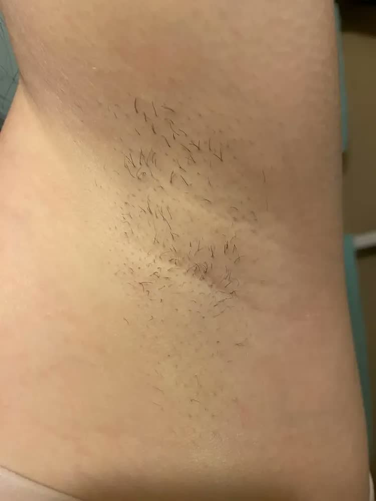 foto de Depilador a Laser IPL Mlay T4 Resfriamento a Gelo 5 Níveis 500000 Flashes