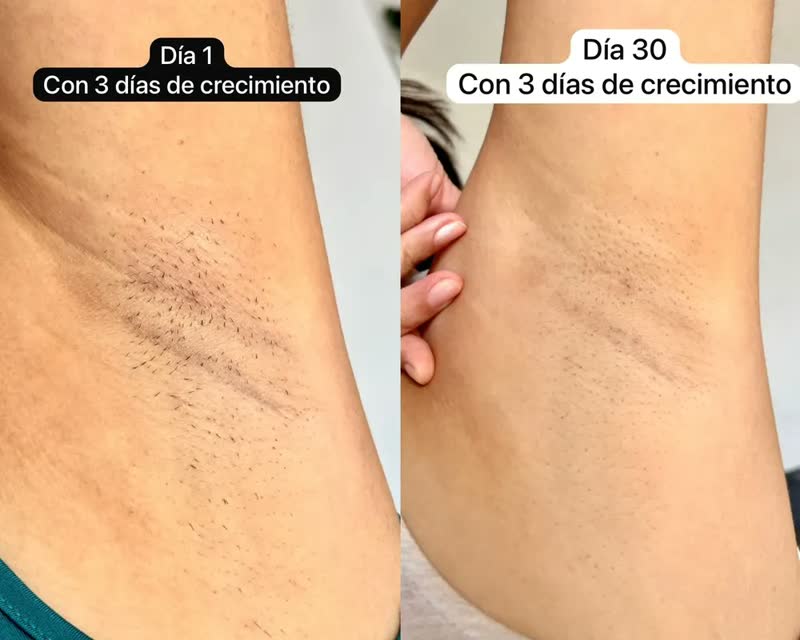 foto de Depilador a Laser IPL Ulike ME Portátil Sem Dor com Resfriamento em Safira 4 Modos Disparo Automático Corpo e Rosto ANVISA