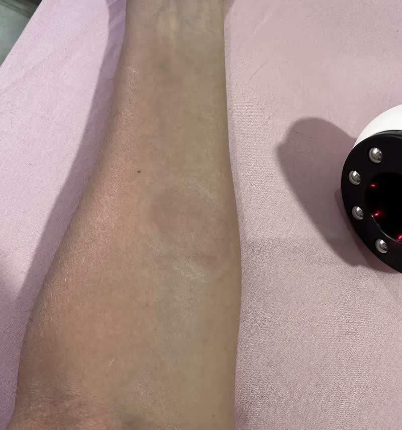 foto de Aparelho Massageador Com Ventosa Anti Celulite Infravermelho Variado